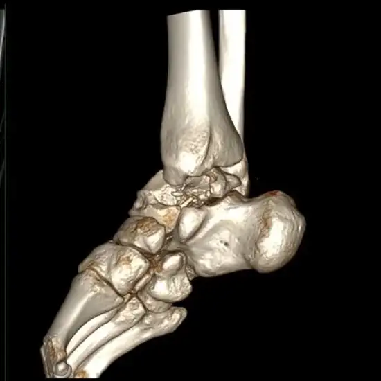 3D CT Scan Right Ankle